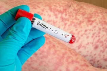 Foto de En pleno desfinanciamiento de la salud pública, se dispara la alerta sanitaria en Argentina por los casos de sífilis: crecieron un 71%