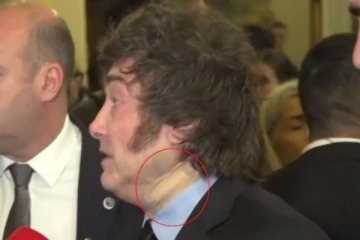Foto de "Golpe en la bañadera": el Gobierno explicó qué le pasó a Milei en el cuello